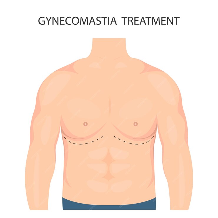 Gynecomastia Surgery: What to Expect Before, During, and After