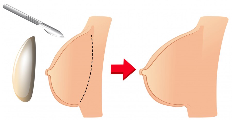 Breast Implant Surgery