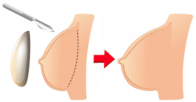 How to Choose the Right Surgeon for Breast Augmentation in Mumbai