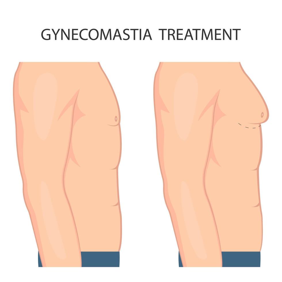 Gynecomastia Surgery