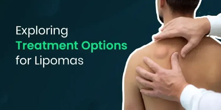 Do You Need Surgery for a Lipoma? Here’s How to Decide.