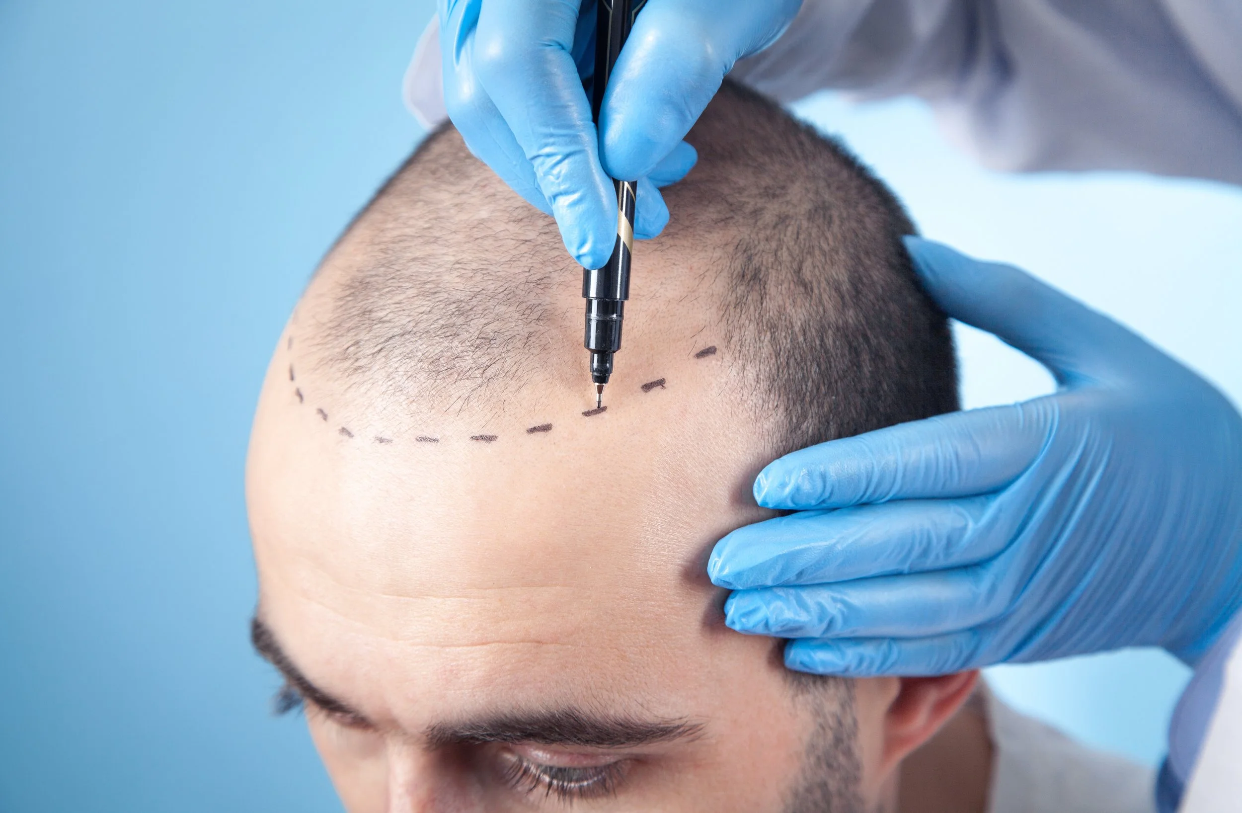 Expert Tips for a Successful Hair Transplant: What You Need to Know