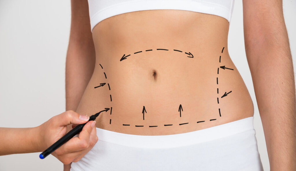 Tummy Tuck Surgery