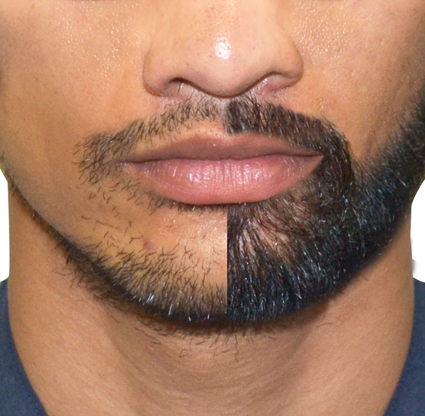 facial hair transplant