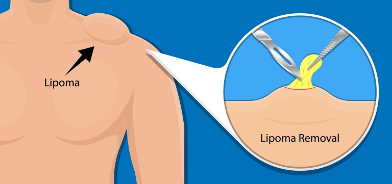 Lipoma Removal