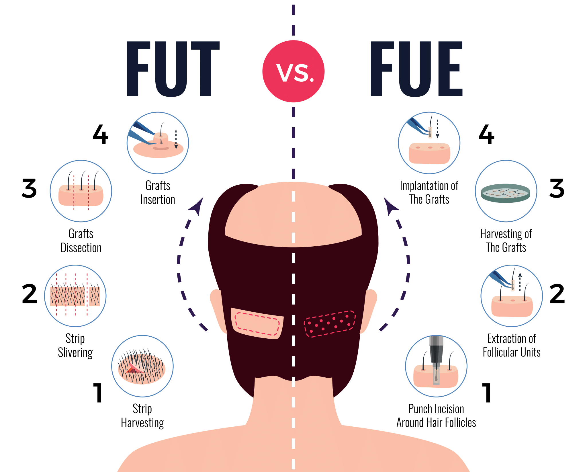 FUE vs FUT Hair Transplant: A Complete Guide to Choosing the Best Method