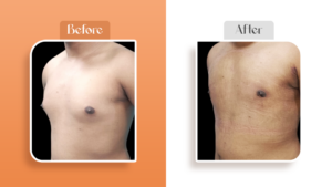 gynecomastia surgery in Navi Mumbai