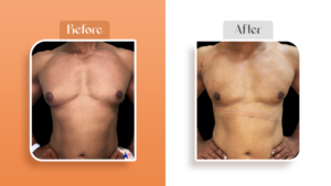 gynecomastia surgery in Navi Mumbai
