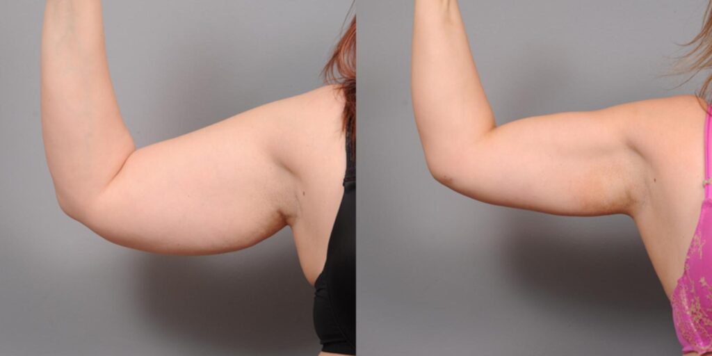 Arm Liposuction Surgery