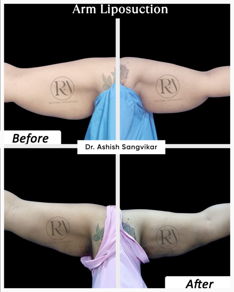 arm lift surgery in Navi Mumbai