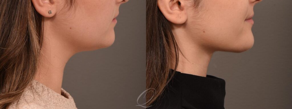 Chin & Neck Liposuction Surgery