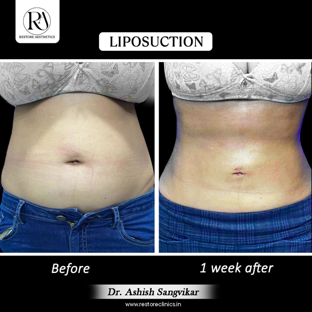  Liposuction Surgery in Navi Mumbai