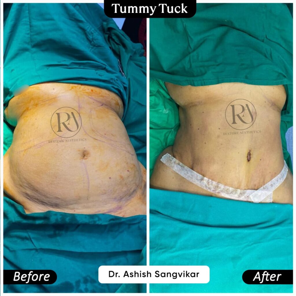 Tummy Tuck Surgery in Navi Mumbai