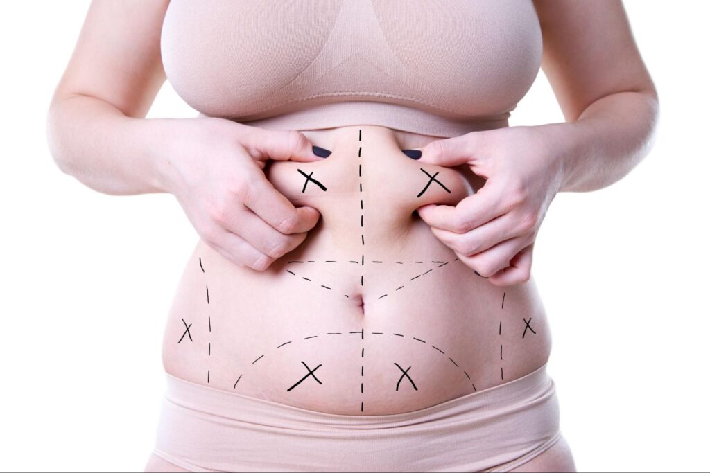 liposuction surgery in navi mumbai
