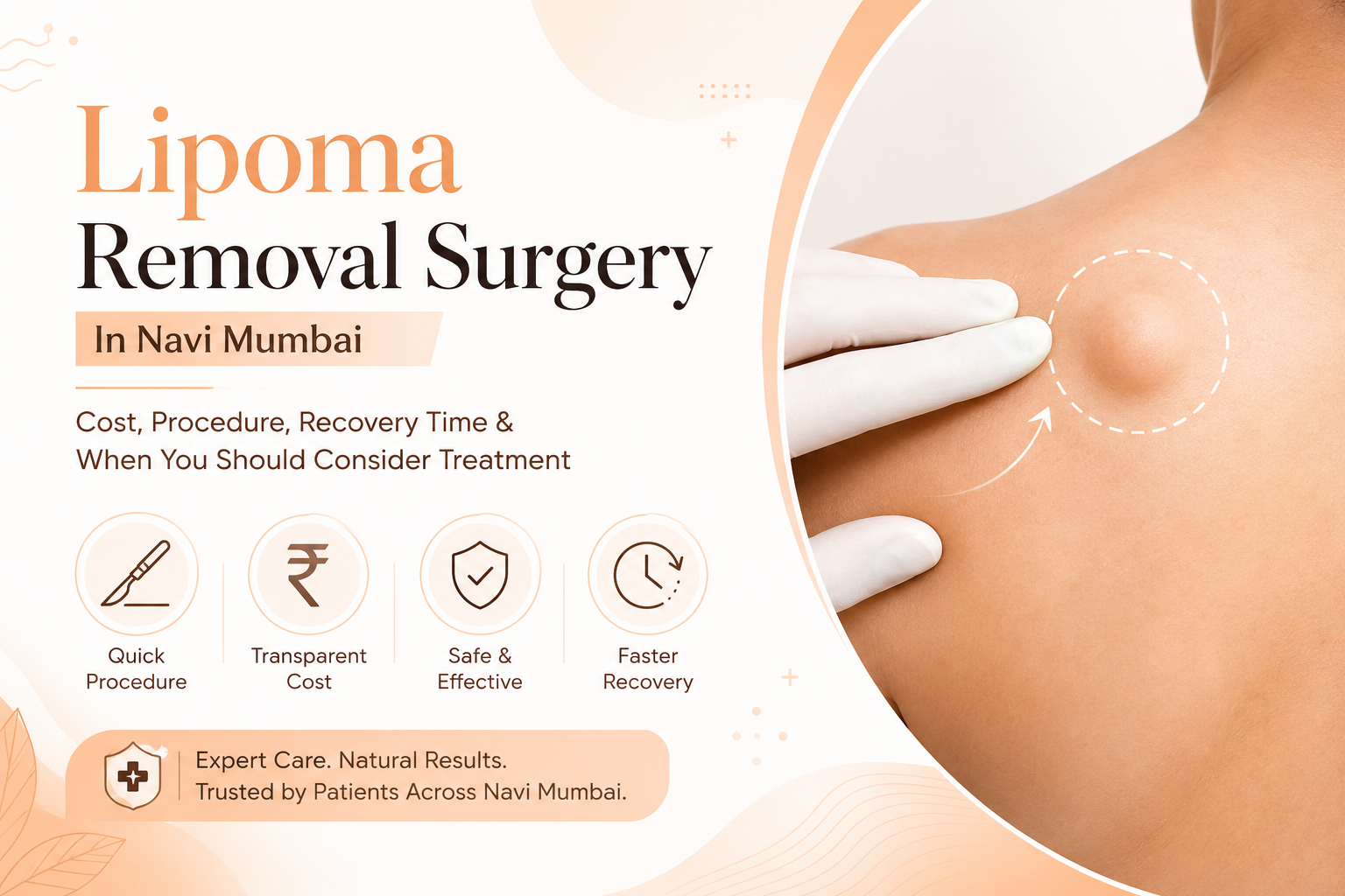 Lipoma Removal Surgery in Navi Mumbai