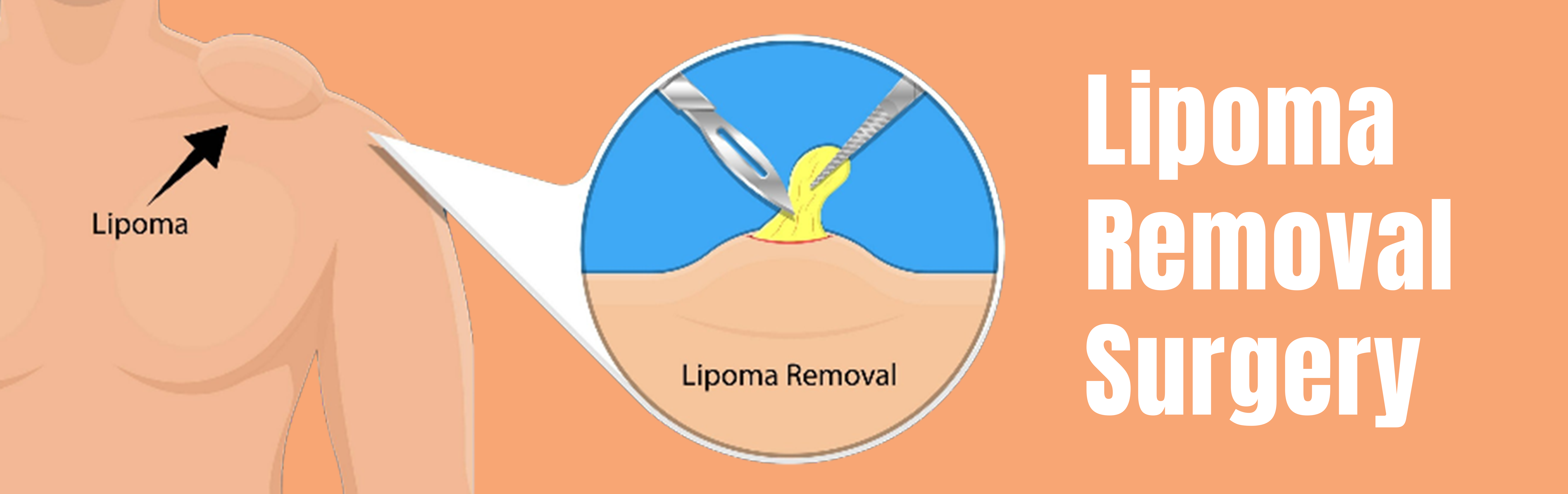 Lipoma Removal Surgery in Mumbai and Navi Mumbai at Restore Clinic by Dr. Ashish Sangavikar