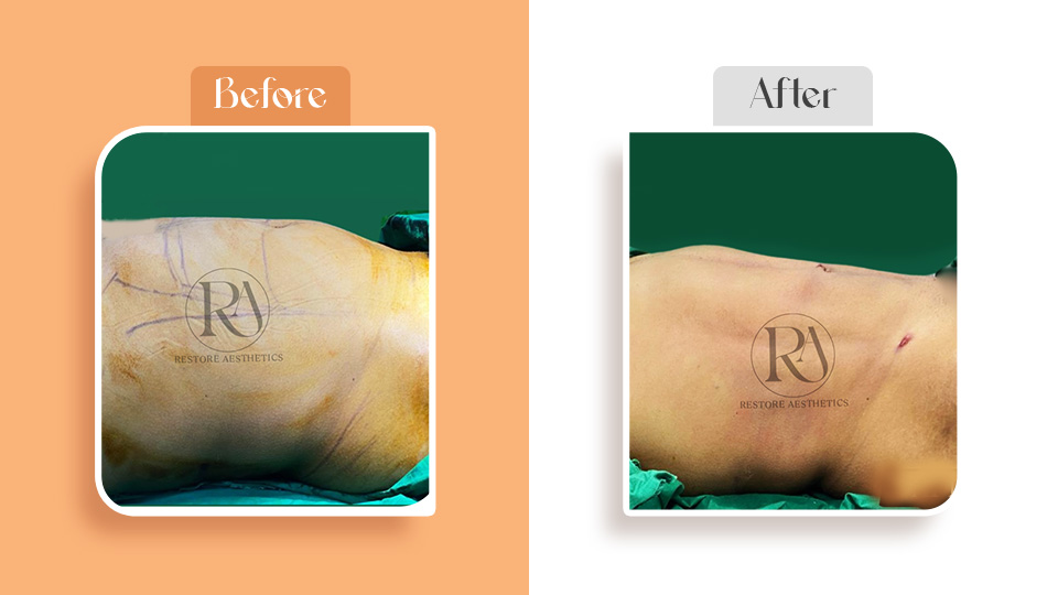 Before and after liposuction surgery in Navi Mumbai