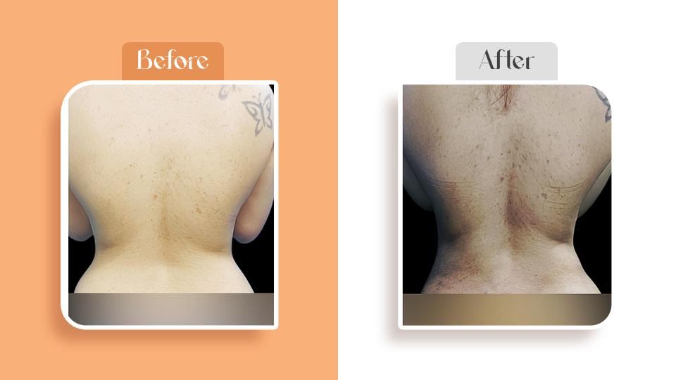 Advanced liposuction treatment results in Navi Mumbai