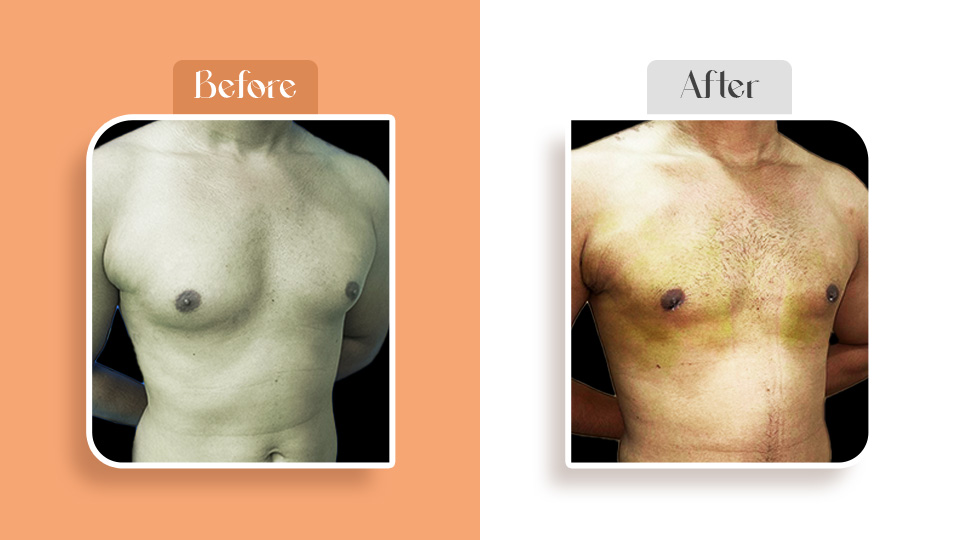 Body contouring after liposuction surgery at Restore Clinics