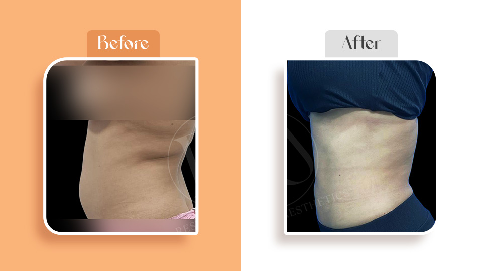 Best liposuction surgeon in Navi Mumbai treatment results