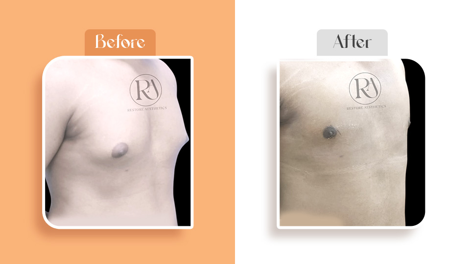 Liposuction fat removal surgery before and after results
