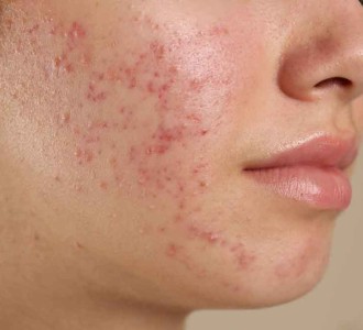 Acne Scars Image