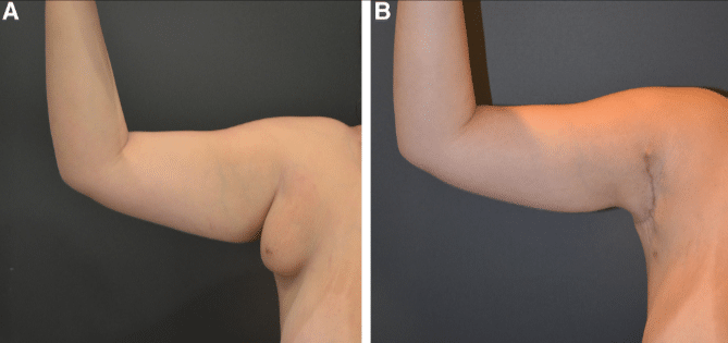 Axillary Breast Removal Surgery Procedure at Restore Clinics Navi Mumbai