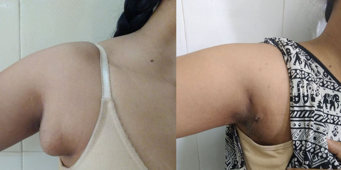 What is Axillary Breast Tissue – Accessory Breast Tissue Navi Mumbai