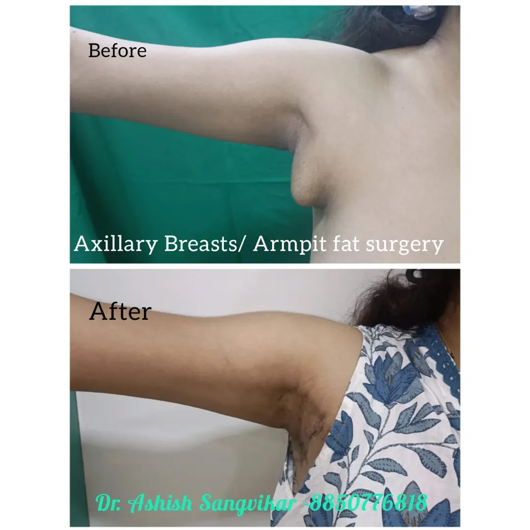 Tummy Tuck Before After Result 1