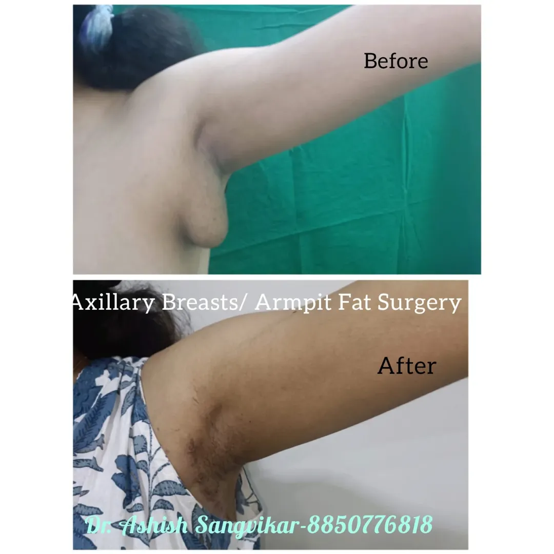 Tummy Tuck Before After Result 2