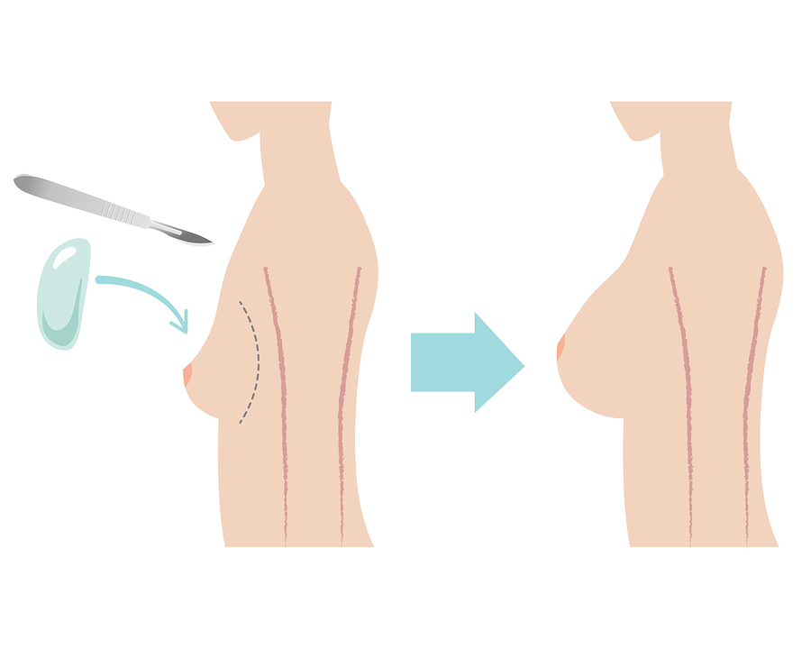 What is Breast Augmentation Surgery – Augmentation Mammoplasty