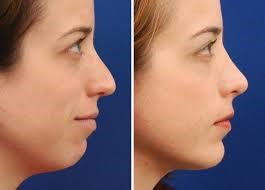 Chin Augmentation Surgery