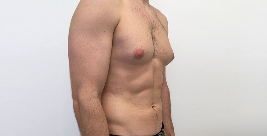 Ideal Candidate for Gynecomastia Surgery Navi Mumbai