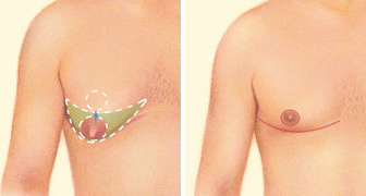 Gynecomastia Surgery Procedure Steps at Restore Clinics Navi Mumbai