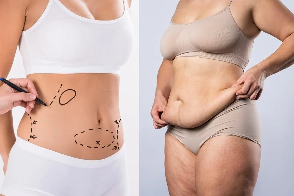 Liposuction vs Tummy Tuck Comparison – Restore Clinics