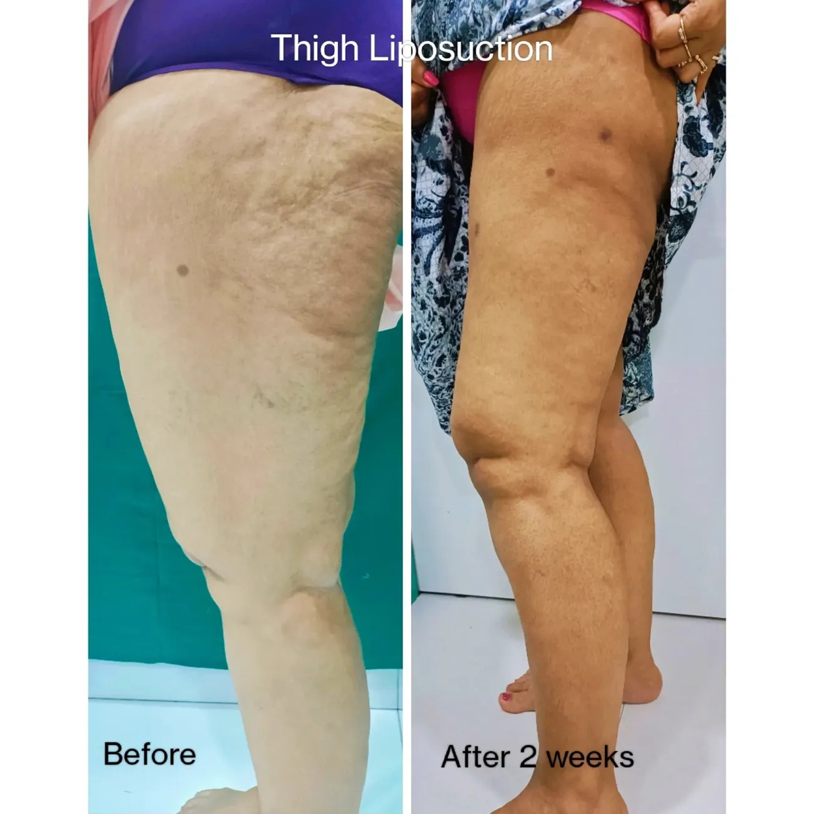 Breast Augmentation Before After 2