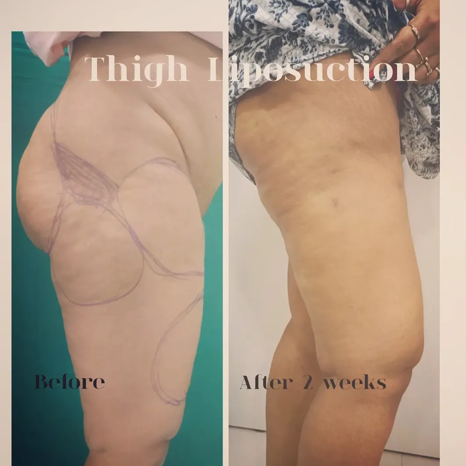 Breast Augmentation Before After 3